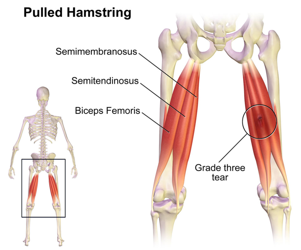 Pulled Hamstring: A grade three hamstring strain is a severe injury. There is an immediate burning or stabbing pain and the individual is unable to walk without pain.