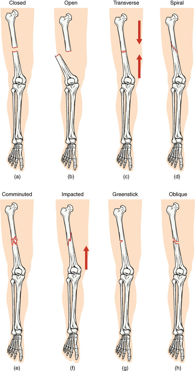 Types of Fractures